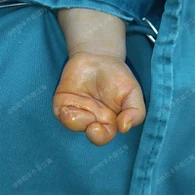 Bedah Sindrom Pita Ketuban