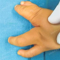 Bedah Tangan Sumbing